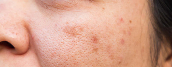 Tout savoir sur l'acné et comment le traiter naturellement